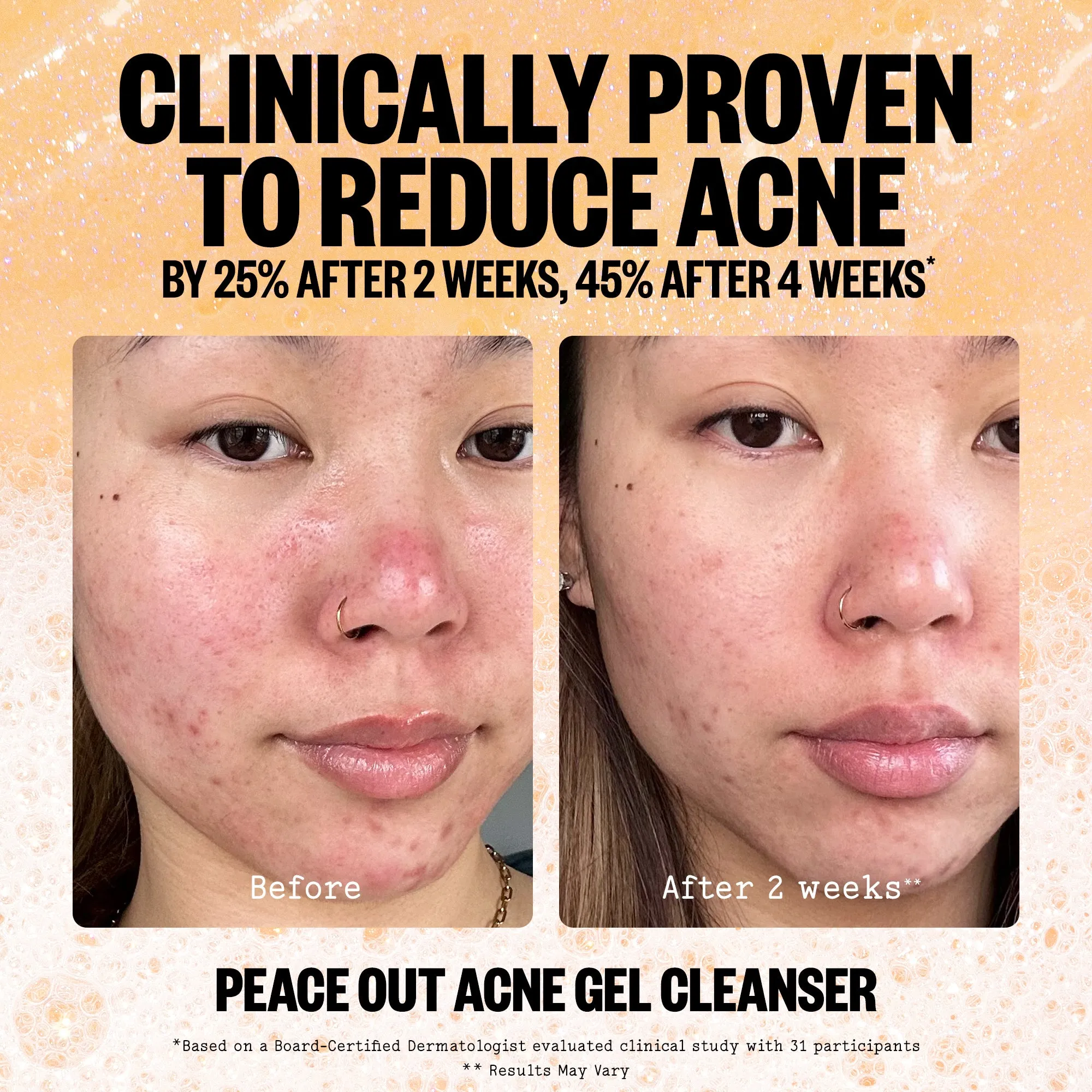 Acne Gel Cleanser