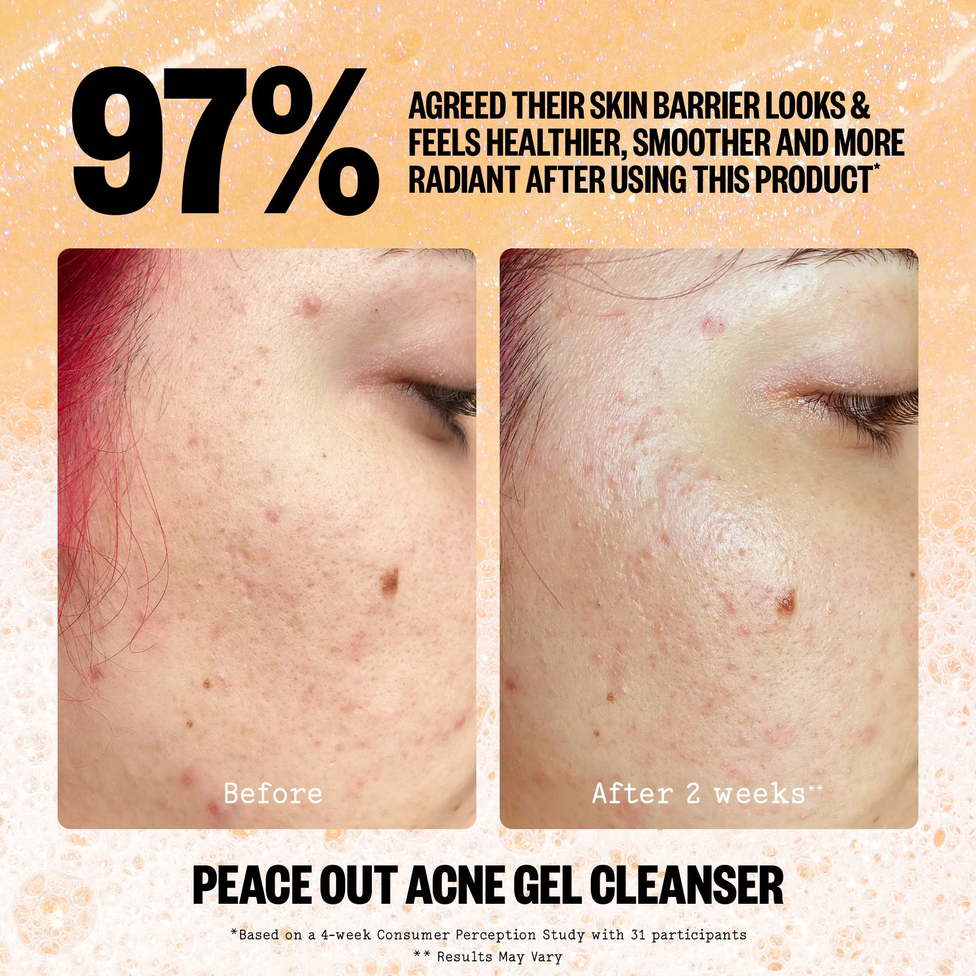 Acne Gel Cleanser